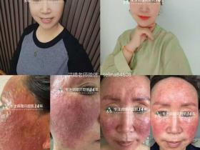 七老严重激素脸案例,从受益者变成守护者