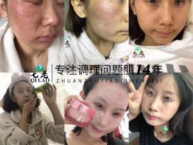 七老激素脸修护案例