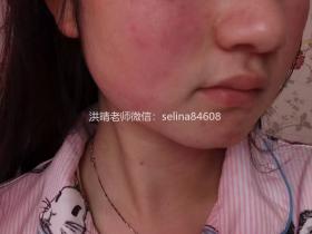 七老激素脸玫瑰皮修复案例