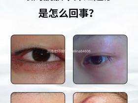 眼周反复红肿痒干痒疹子过敏怎么办?