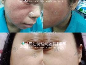 七老激素脸修复案例