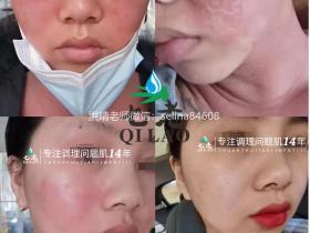 七老严重激素脸修护案例