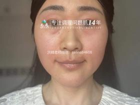 七老反复过敏修护案例