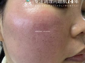 七老发红发烫大红脸红黑脸修护案例