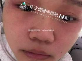 七老脂溢性皮炎修护传明酸反馈