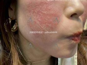 七老激素脸修护案例
