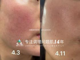 七老传明酸→红黑脸,反复红烫胀,疹子暗沉暗黄色沉的福音