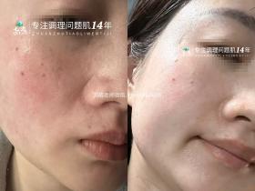 七老传明酸精华14天变化对比效果反馈