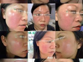 七老红烫肌大红脸,发红发烫修护案例