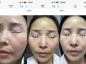 七老黑红脸用传明酸9天的对比变化效果