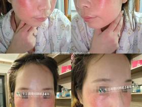 七老屏障受损敏感肌角质层薄修护案例