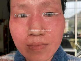 七老反复过敏性爆发性皮炎修护案例
