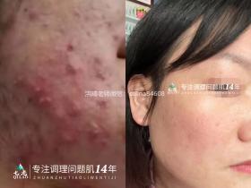 七老严重痘痘肌修护案例