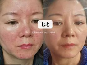 七老玫瑰痤疮修护案例