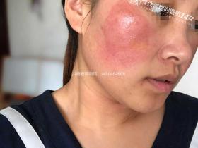 七老激素脸红肿烫痒疹子疙瘩渗液结痂修护案例