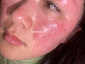 七老激素脸玫瑰➕脂溢性皮炎修护案例