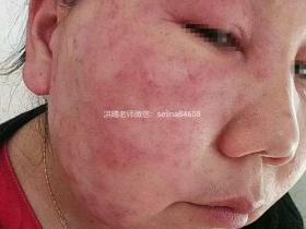 七老激素脸修护案例