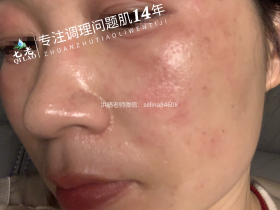 七老眼周反复过敏案例