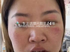 七老激素脸红肿痒反复过敏修护案例