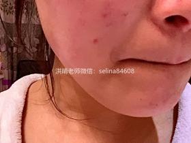 七老屏障受损剥脱祛斑敏感发红修护案例