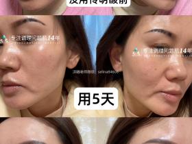 七老传明酸→修护抗炎美白提亮于一体,黑红脸的救星