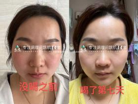 七老四重肽胶原蛋白7天前后对比