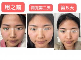 七老胶原水光五天的前后对比🆚