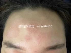 七老屏障受损反复敏感长痘修护案例