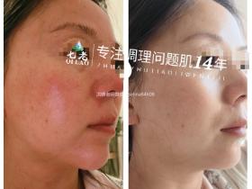 七老胶原水光修护案例反馈