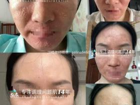 七老激素脸干红痒疹子渗液流黄水结痂修护案例