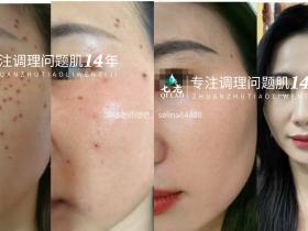 斑点敏感痘痘肌修护案例