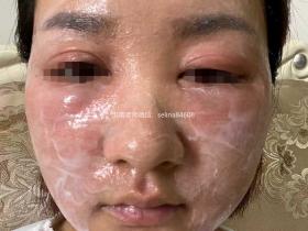 七老皮肤反复过敏红肿痒疹子修护案例