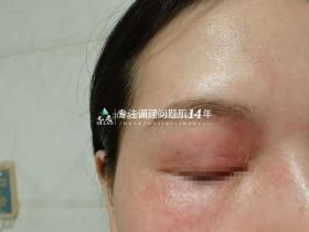 七老过敏脸红干烫痒疹子脱皮修护案例