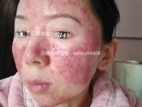 七老激素脸玫瑰痤疮修护成功案例