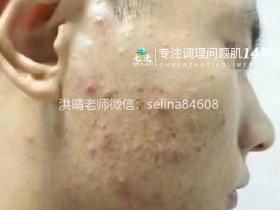 七老脓包痘痘修护案例