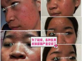 七老反复长痘敏感发红发烫修护案例