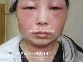 七老激素脸修护案例