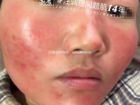 七老激素脸玫瑰痤疮修护案例