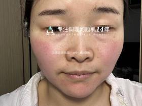 七老屏障受损敏感过敏红肿痒修护案例