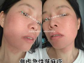 七老皮肤过敏反复红肿烫痒疹子修护案例