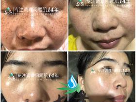 七老发红敏感斑点修护案例
