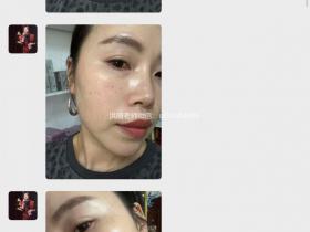 七老发红发烫红烫肌修护案例