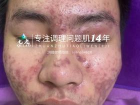 七老激素痘囊肿脓包痘痤疮痘修护案例