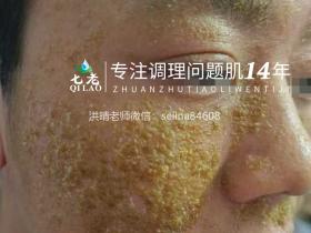 七老严重激素脸流黄水结痂渗液修护记录✍️
