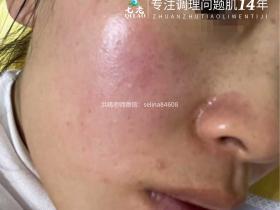 七老敏感过敏发红发烫起疹子修护案例