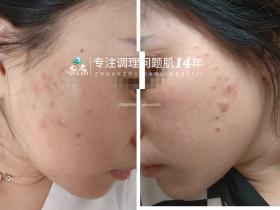 七老痘痘肌痘印修护案例反馈