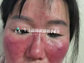 七老激素脸玫瑰痤疮烂脸修护案例