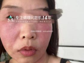 七老激素脸红烫痒流黄水结痂修护案例
