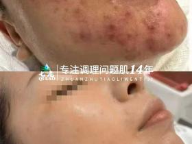 七老顽固粉刺炎性红痘痘修护案例