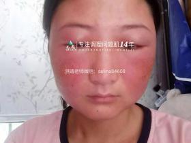 七老激素脸反复红肿烫痒疹子疙瘩修护案例